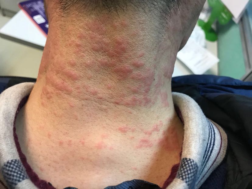 1、膏藥過敏怎么辦？