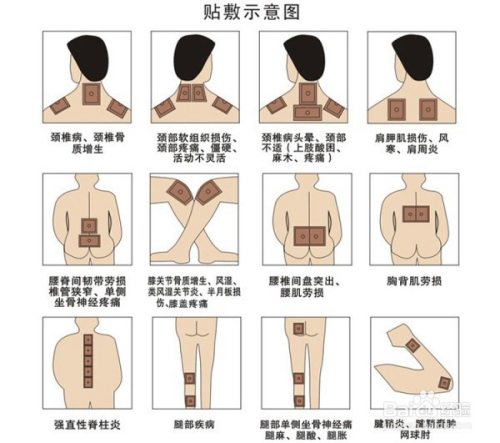 1、肩痛買(mǎi)什么膏藥可以貼？