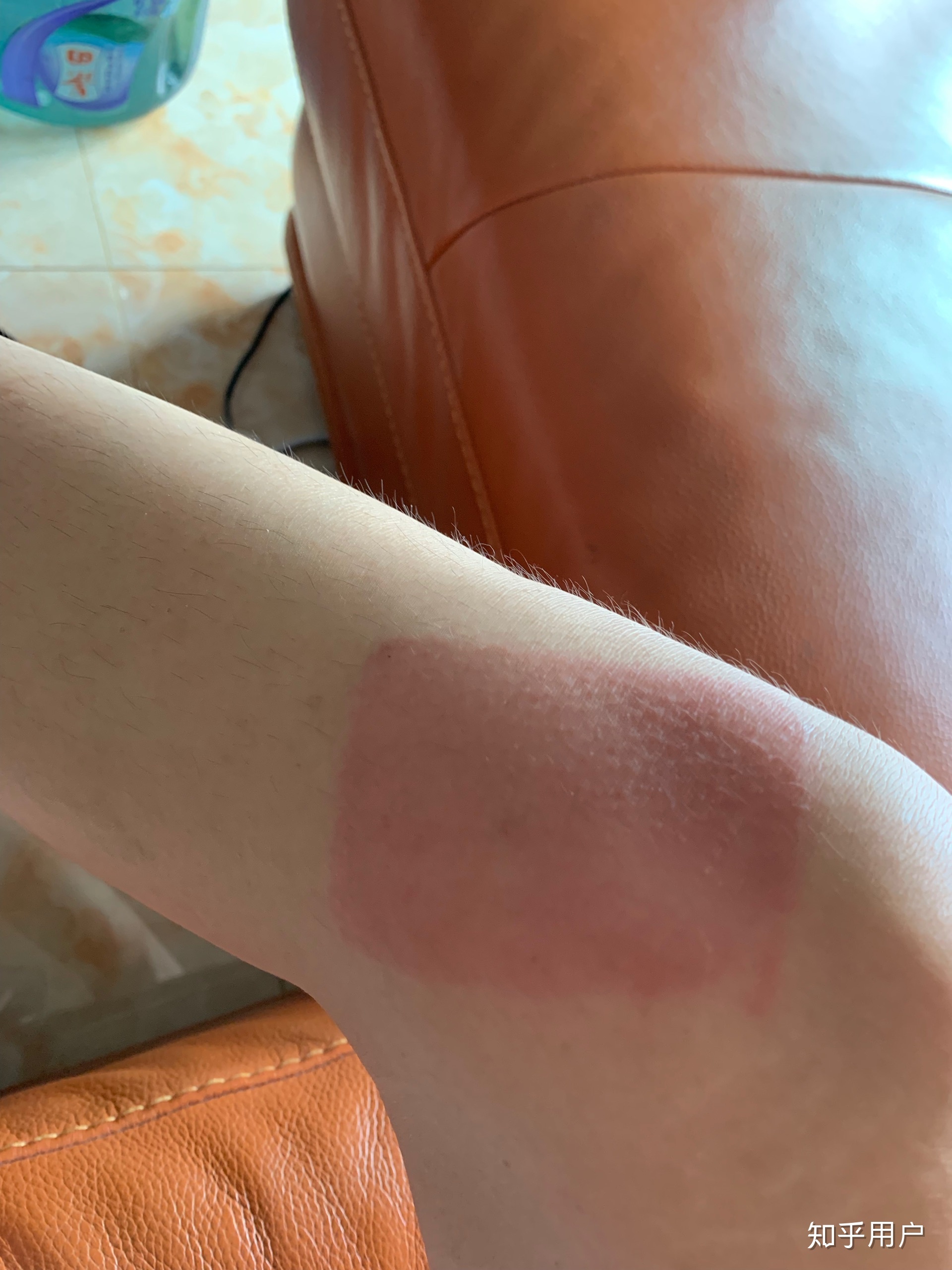 2、貼膏藥的地方有很多紅疙瘩，好不好？